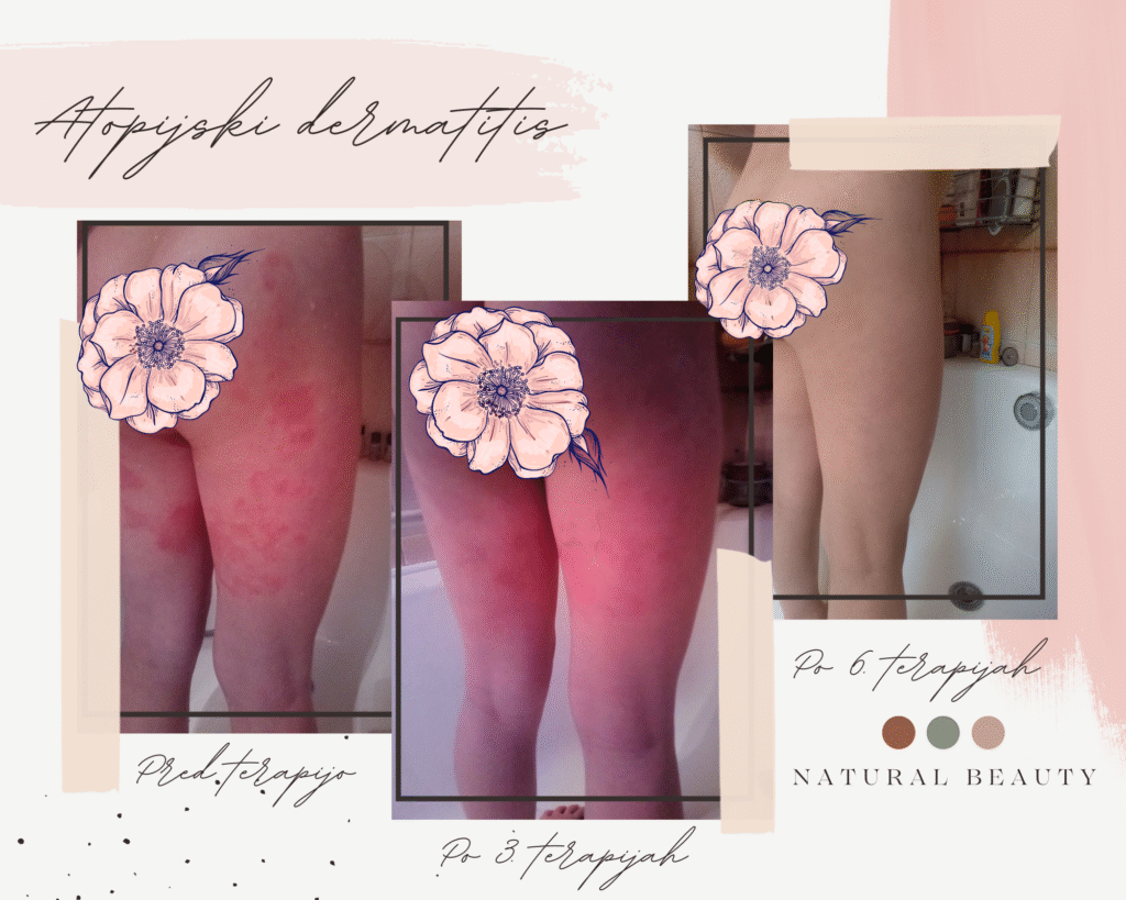 celični spomin dermatitis natural beauty